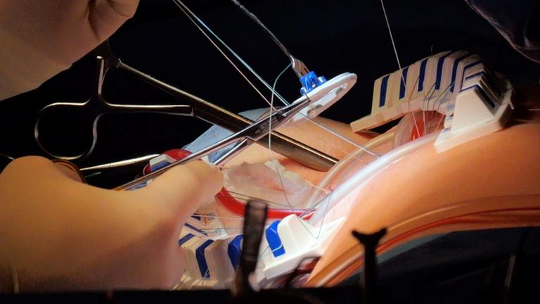 Minimalinvasive Operation bei einer Mitralklappeninsuffizienz.Dabie wird die defekte Herzklappe repariert und mit einem Ring stabilisiert.