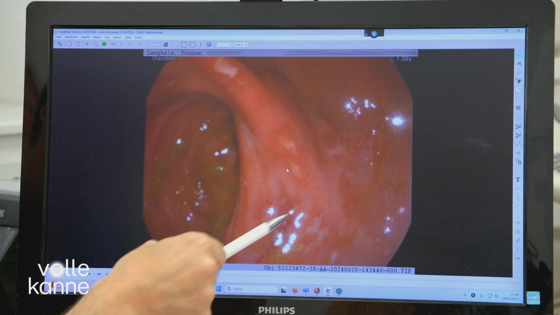 Morbus Crohn