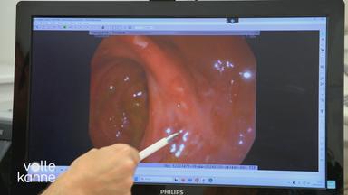 Morbus Crohn