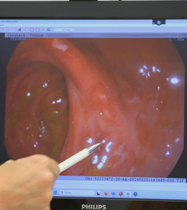 Morbus Crohn
