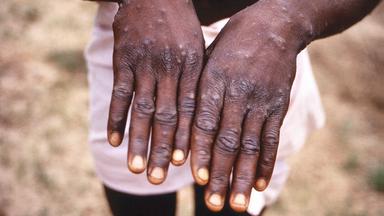 Archiv: Die Hände eines Patienten aus Kongo mit Affenpocken