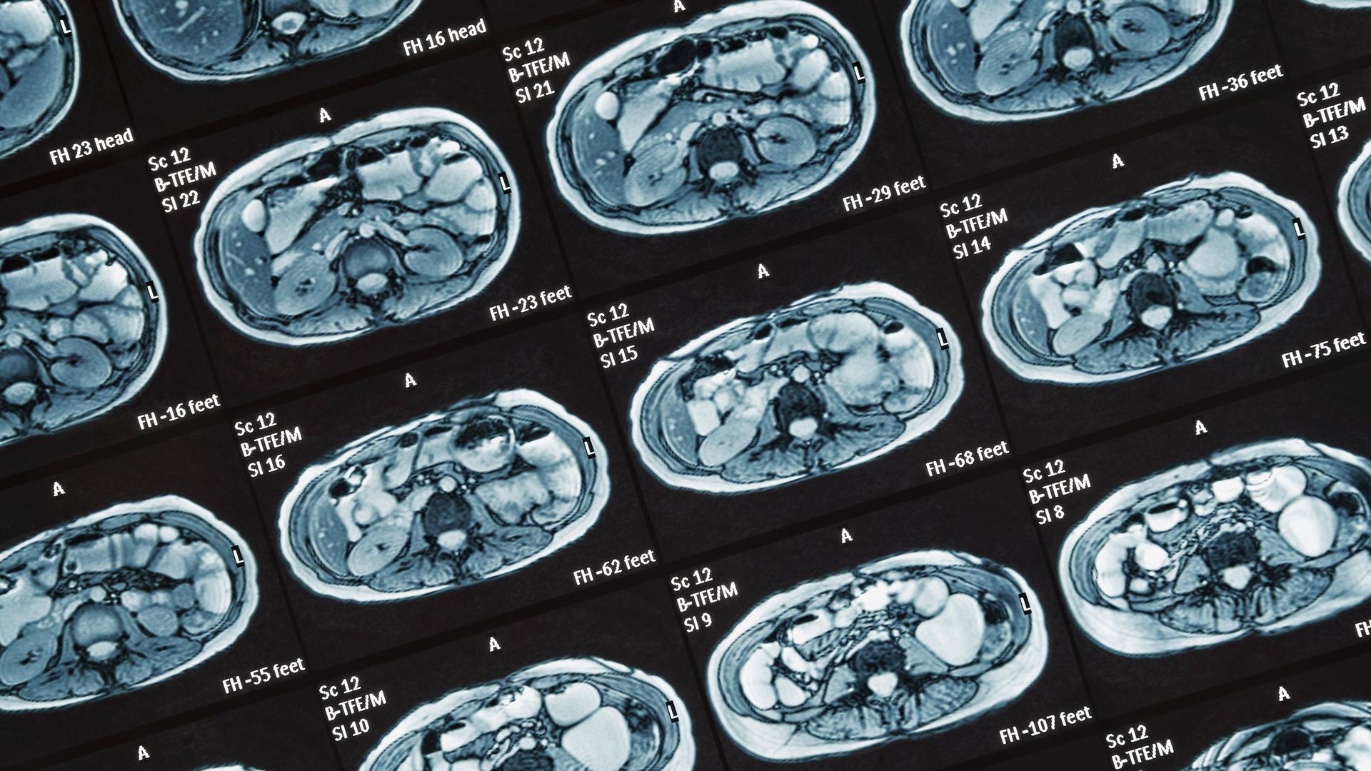 MRT-Untersuchung Darm