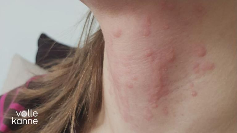 Chronisch spontane Nesselsucht 