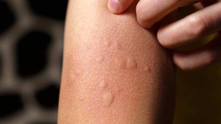 An einem Oberarm sind die für eine Nesselsucht typischen juckenden Quaddeln als geschwollene Erhebungen auf der Haut zu sehen.