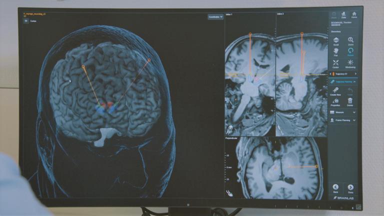 Neue Therapien gegen Parkinson