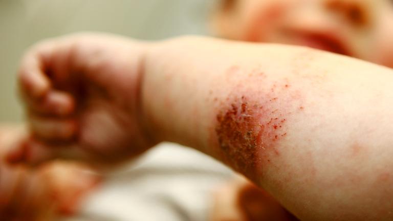 Kind mit Neurodermitis am Unterarm.