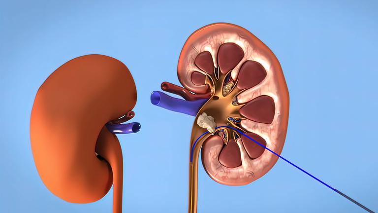 Eine 3D-Illustration von einem Querschnitt einer Niere mit Nierensteinen.
