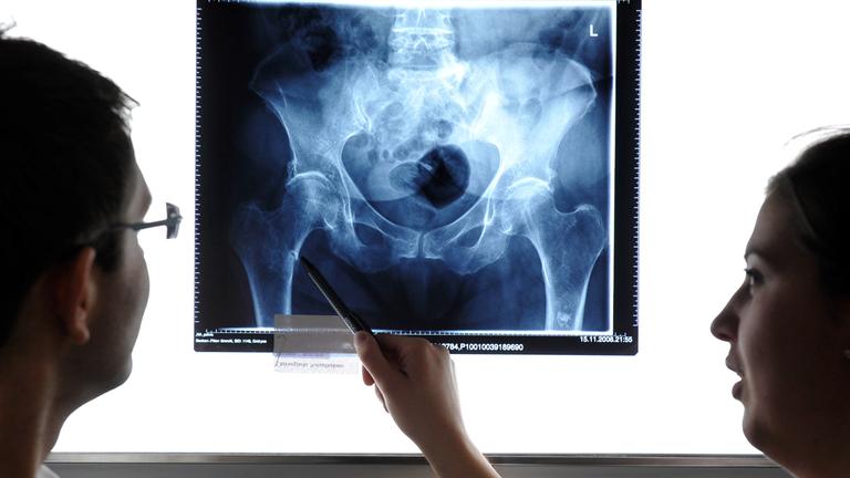 Ärzte betrachten einen Oberschenkelhalsbruch auf einem Röntgenbild.