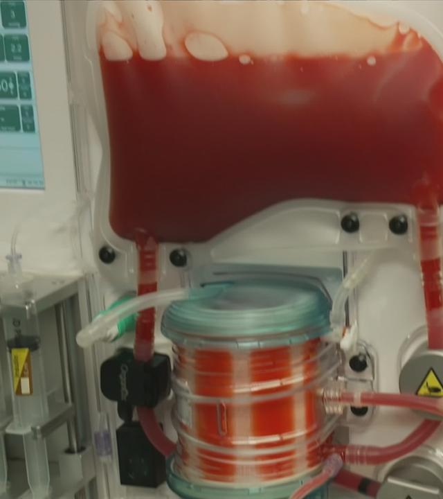 Wegen der besseren Haltbarkeit durch die Maschinenperfusion könnte sich die Anzahl der Spenderlebern erhöhen.