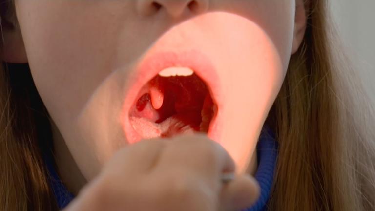 Pfeiffersches Drüsenfieber