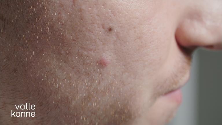 Pickel im Gesicht