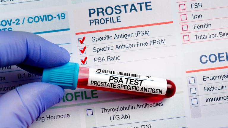 Ein Blutproberöhrchen mit der Aufschrift "PSA Test - Prostate Specific Antigen".