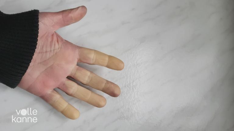 Raynaud-Syndrom