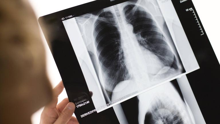 Arzt betrachtet Röntgenbildaufnahme mit Lungenkrebs.