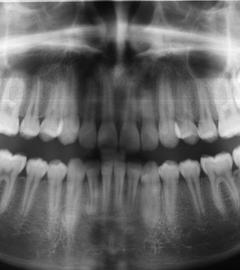 Röntgenbild Kiefer mit Weisheitszähnen