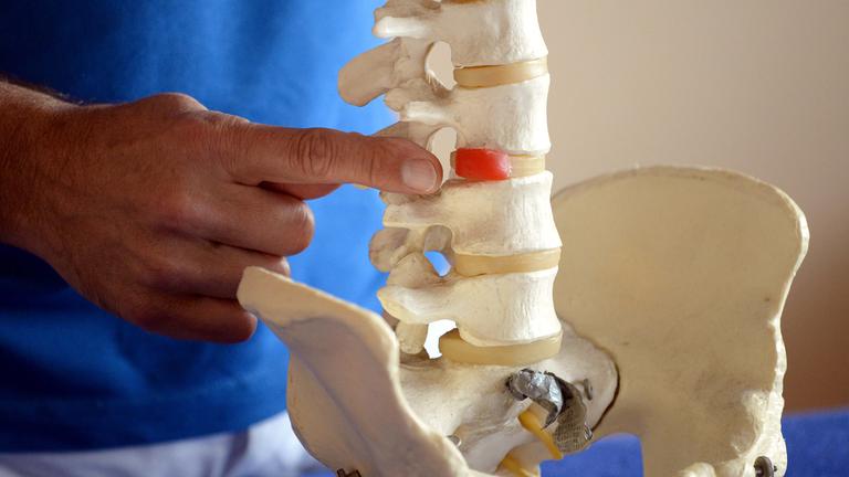 Bandscheibenvorfall behandeln