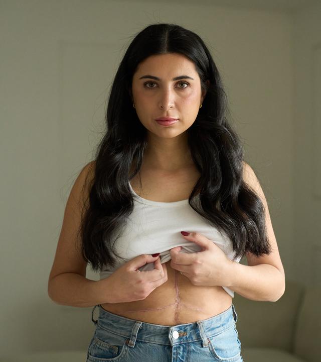 Sarah trägt ein weißes Trägertop, welches sie mit beiden Händen hochhält. Man sieht eine große Narbe über ihren Bauch. Sie schaut in die Kamera. 