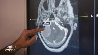 Schädelbasistumor: Diagnose und Behandlung