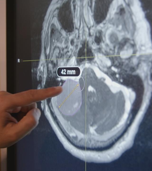 Schädelbasistumor: Diagnose und Behandlung