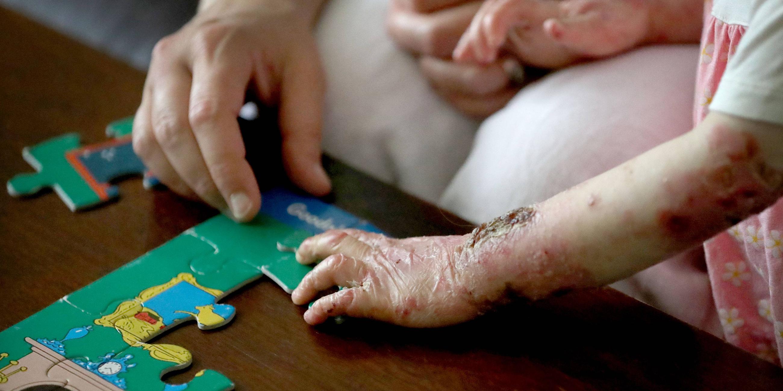 Hautlisionen als Symptom der Schmetterlingskrankheit, Epidermolysis bullosa