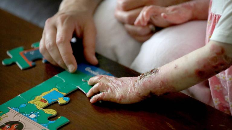 Hautlisionen als Symptom der Schmetterlingskrankheit, Epidermolysis bullosa
