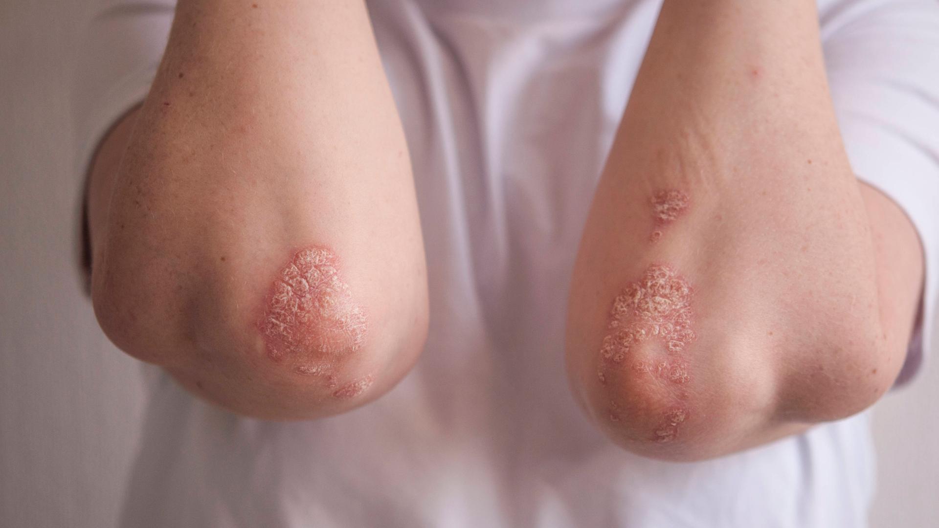 An den Ellenbogen eines Betroffenen sind die typischen roten und schuppenden Hautstellen der Psoriasis, einer Schuppenflechte deutlich zu sehen.