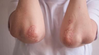 An den Ellenbogen eines Betroffenen sind die typischen roten und schuppenden Hautstellen der Psoriasis, einer Schuppenflechte deutlich zu sehen.