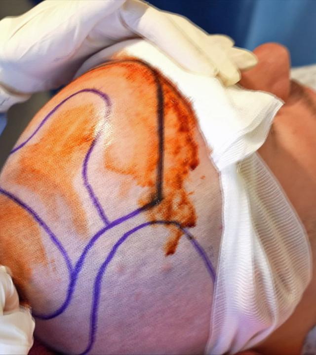 Haartransplantation
