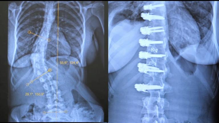 Zwei Röntgenbilder von Wirbelsäulen nebeneinander.