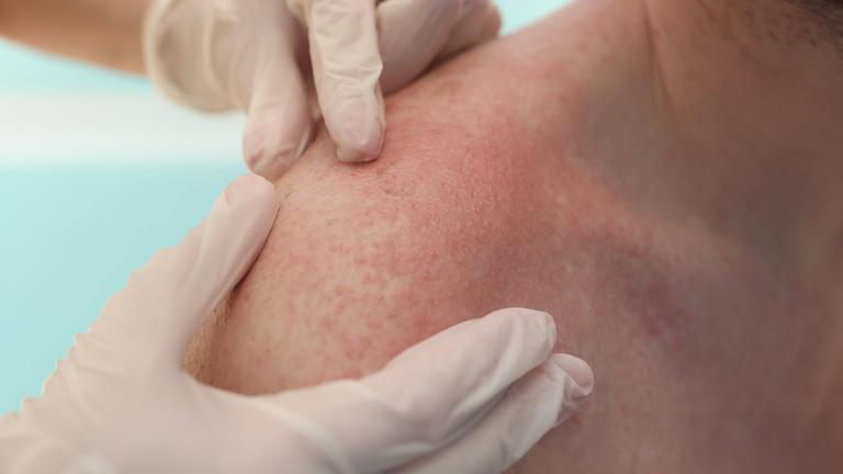 Zwei Hände in Handschuhen Tasten Männerschultern ab, auf denen sich rote Pusteln einer Sonnenallergie zeigen.