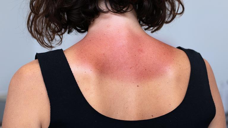 Junge Frau mit starken Rötungen und schmerzhafter Haut im Nackenbereich nach Sonnenbaden.