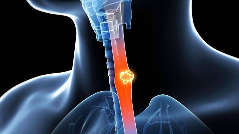 Eine 3D-animierte Illustration von Speiseröhrenkrebs.