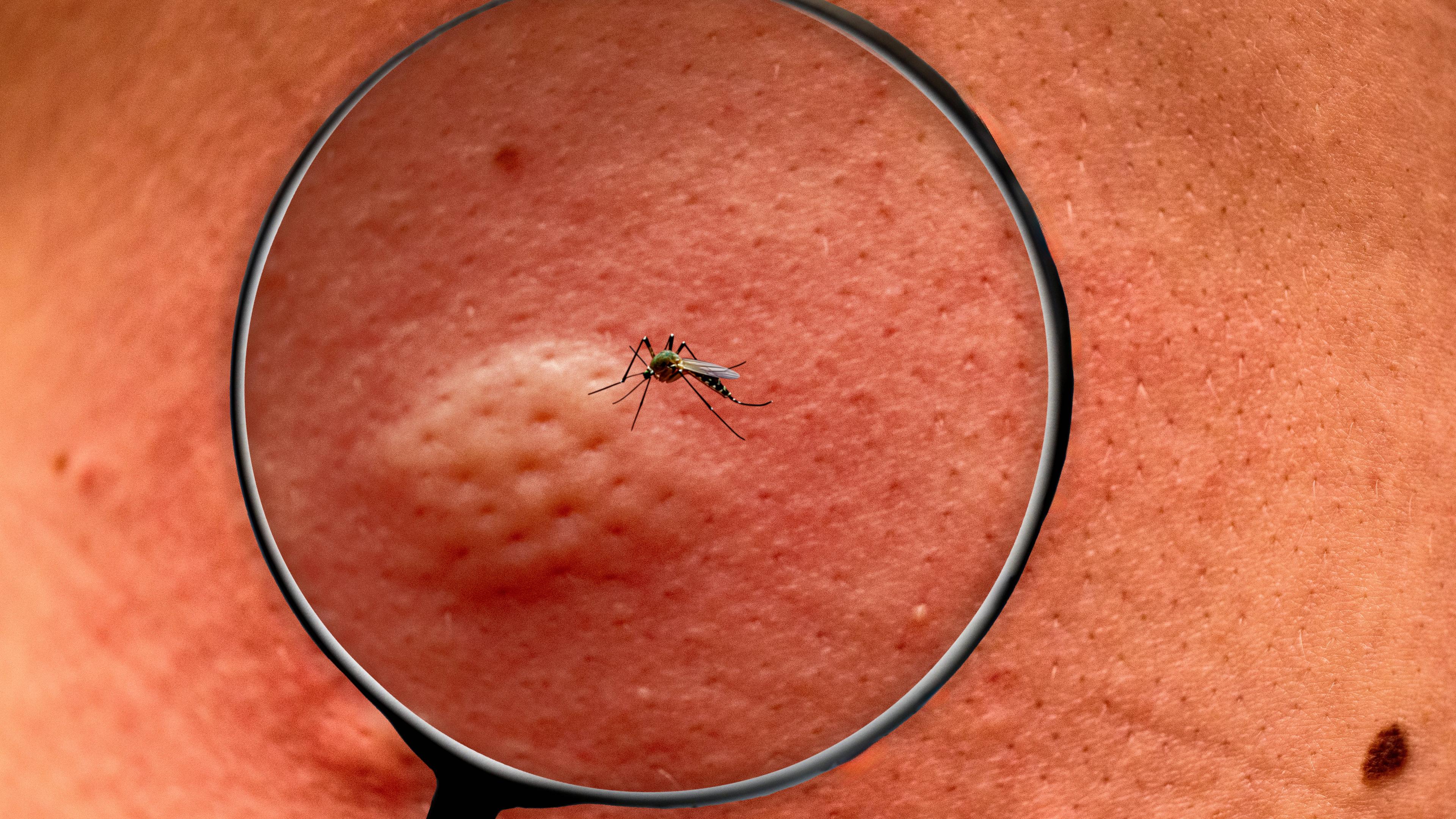 Eine Lupe ist auf eine Hautstelle gerichtet, auf der eine Stechmücke sitzt. Durch den Stich hat sich bereits eine Quaddel gebildet.