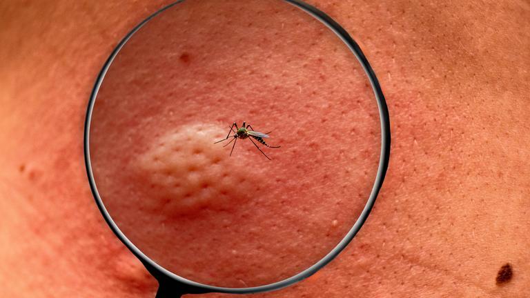 Eine Lupe ist auf eine Hautstelle gerichtet, auf der eine Stechmücke sitzt. Durch den Stich hat sich bereits eine Quaddel gebildet.