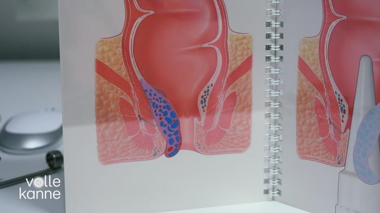 Bild-Darstellung von Hämorrhoiden