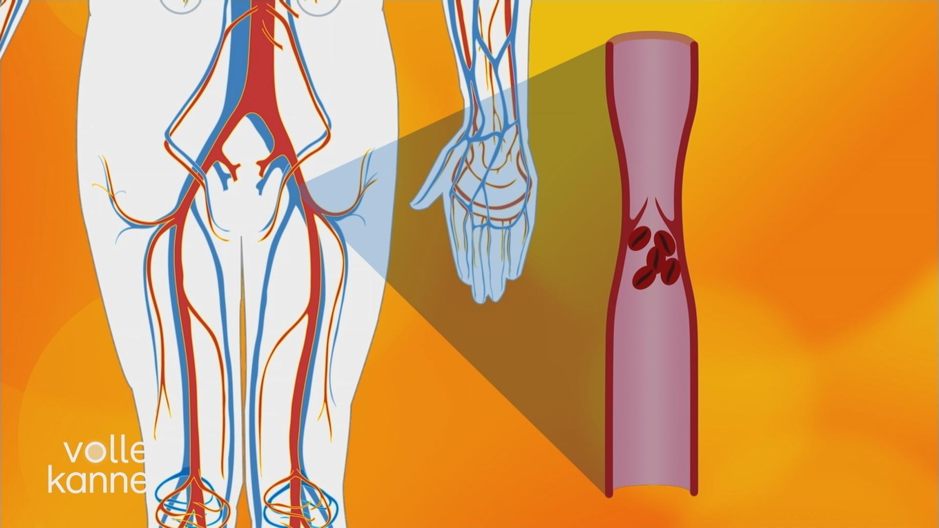 Schockdiagnose Thrombose