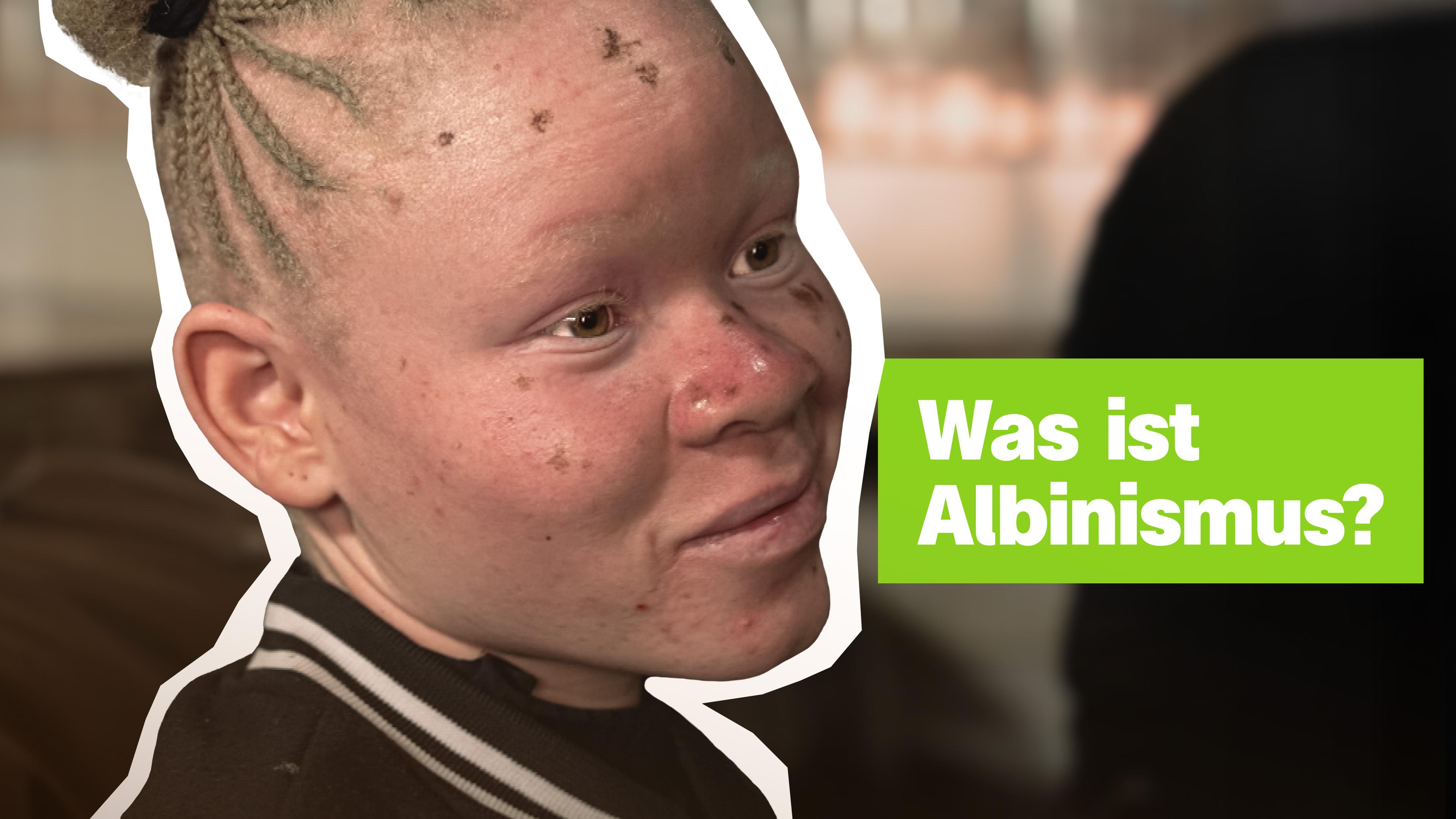 Portrait eines Kindes mit Albinismus-Erkrankung  - darauf Schrift: Was ist Albinismus?