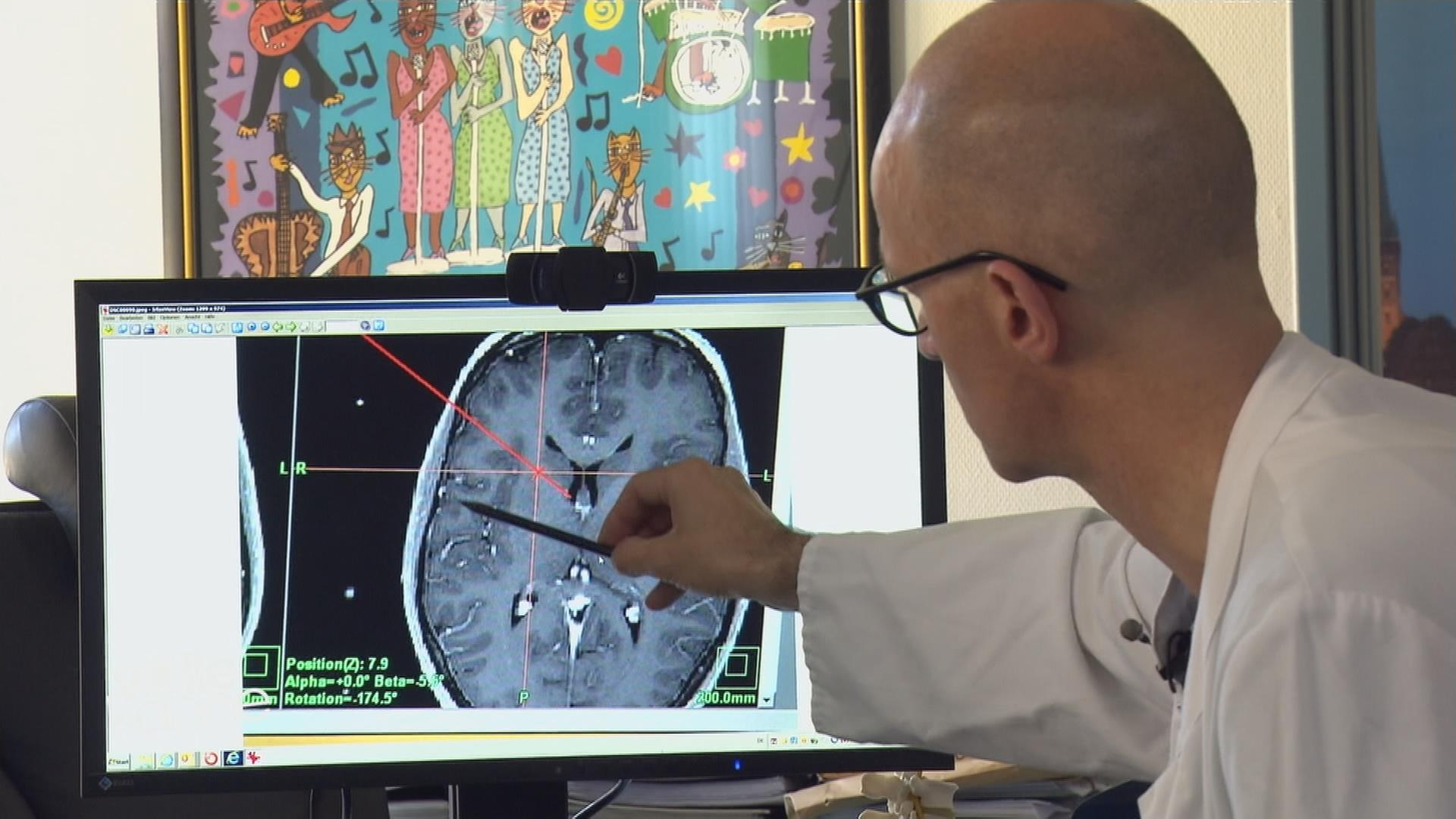 Tiefe Hirnstimulation bei Zwangsstörung