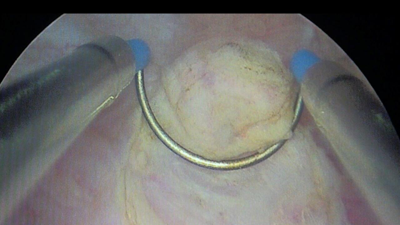 Bild von einer Blasenspiegelung. Zu sehen ist die Blasenschleimhaut mit einem Tumor, der mittels Elektroschlinge abgetragen wird.