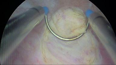 Bild von einer Blasenspiegelung. Zu sehen ist die Blasenschleimhaut mit einem Tumor, der mittels Elektroschlinge abgetragen wird.
