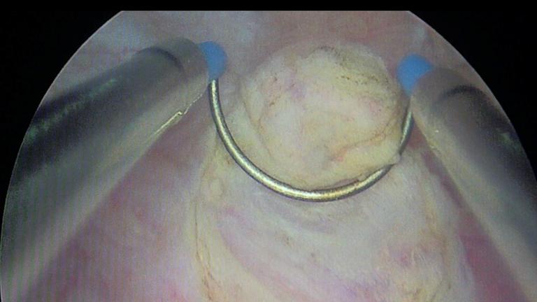 Bild von einer Blasenspiegelung. Zu sehen ist die Blasenschleimhaut mit einem Tumor, der mittels Elektroschlinge abgetragen wird.