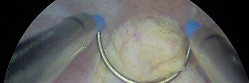 Bild von einer Blasenspiegelung. Zu sehen ist die Blasenschleimhaut mit einem Tumor, der mittels Elektroschlinge abgetragen wird.