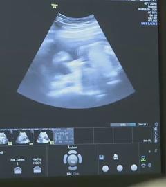 Untersuchung zu Trisomie