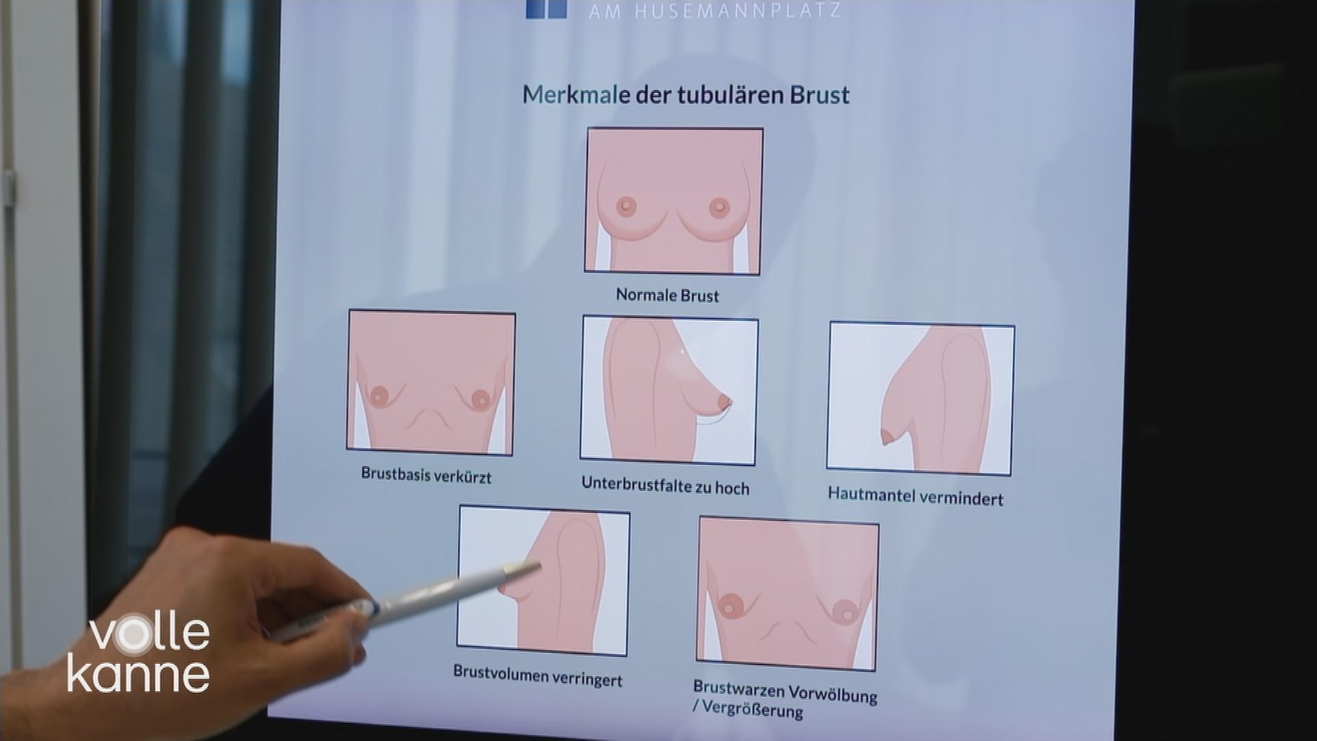 Tubuläre Brust
