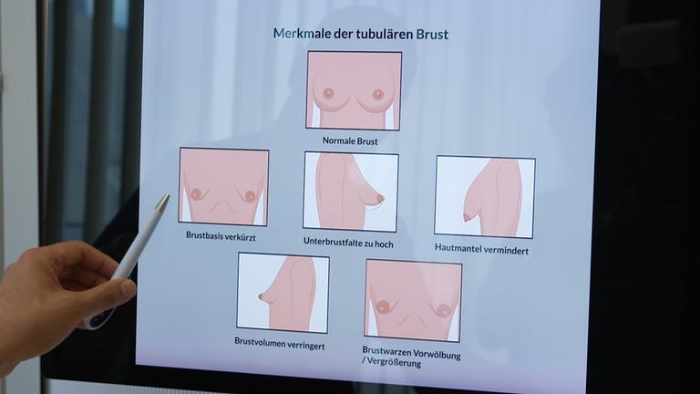 Auf dem Bild sind Grafiken zu den Merkmalen einer tubulären Brust, einer Brustfehlbildung, zu sehen.