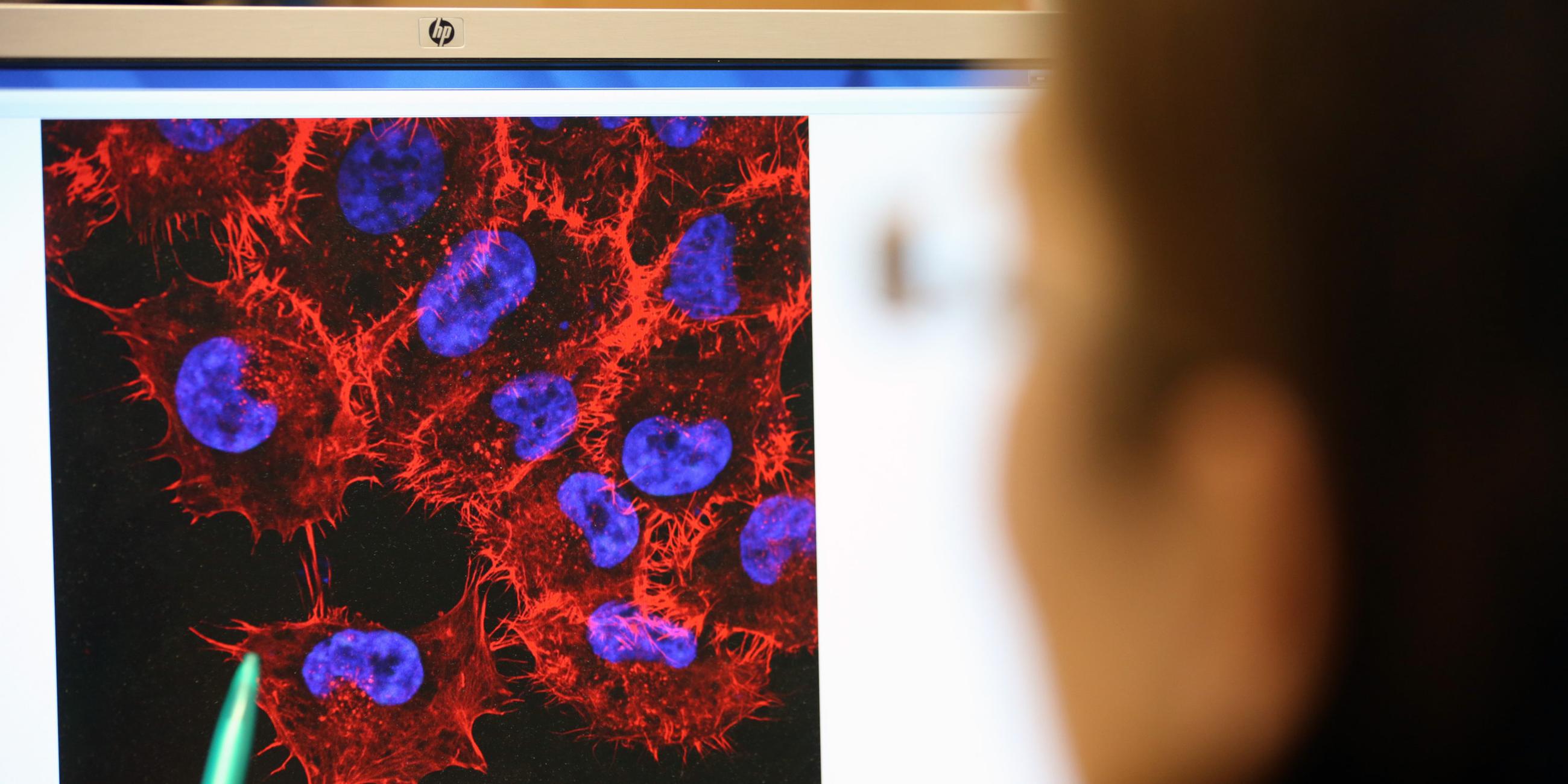 Aufklärung von Tumor-Metastasierung, Archivbild
