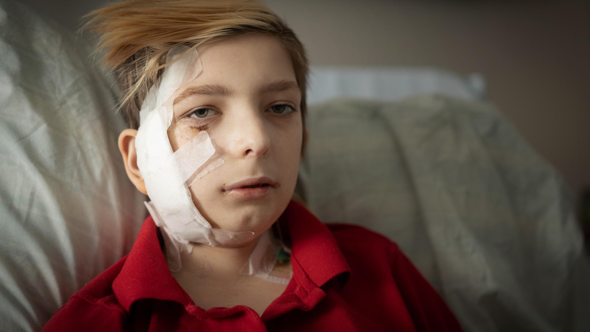 Ein Junge in rotem T-shirt und Verletzungen im Gesicht.