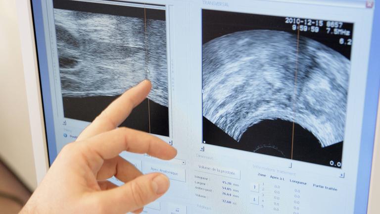 Mit Ultraschall gegen Prostatakrebs
