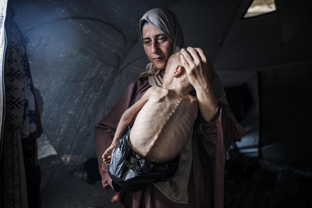 Unterernährtes Kleinkind in Gaza kämpft angesichts anhaltender israelischer Angriffe um sein Leben