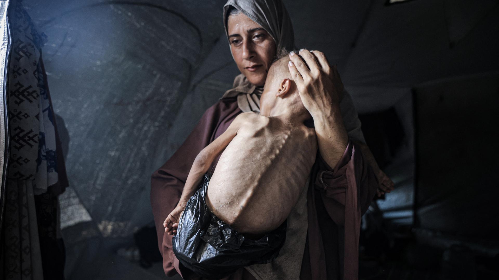 Unterernährtes Kleinkind in Gaza kämpft angesichts anhaltender israelischer Angriffe um sein Leben